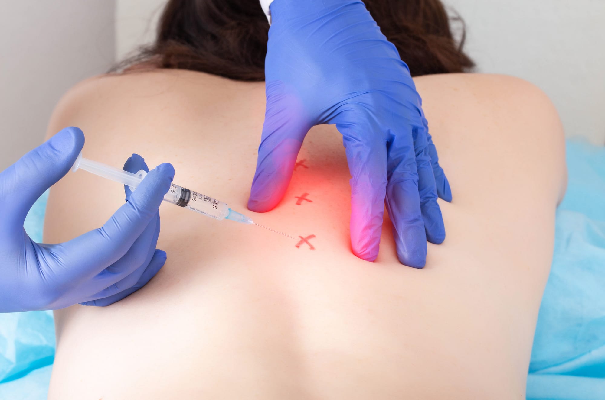 Patient receiving trigger point injection for back pain relief at YA Medical Urgent Care in Phoenix, AZ